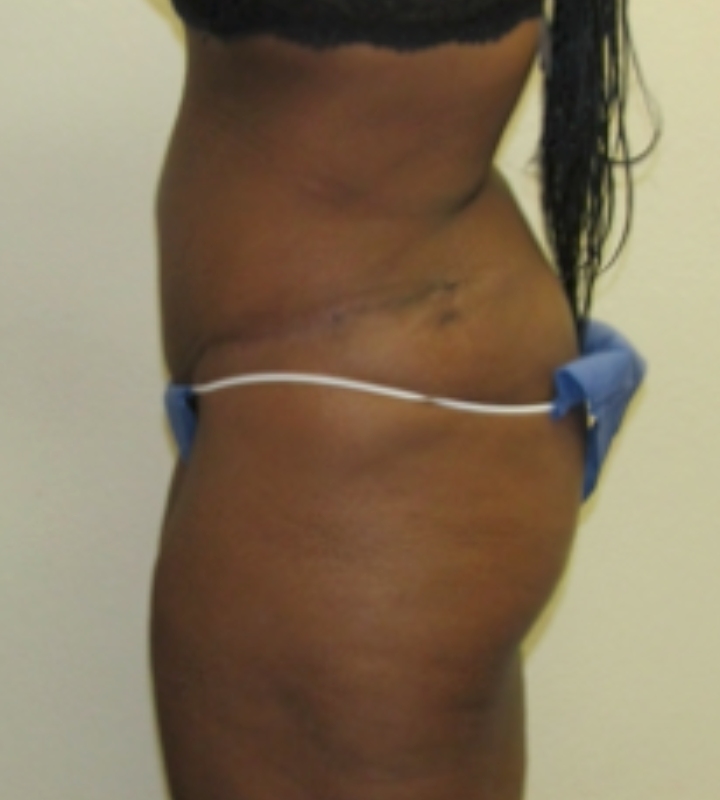 Tummy tuck before & after photo