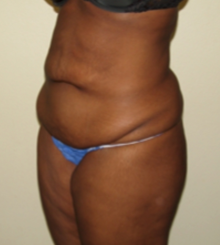 Tummy tuck before & after photo