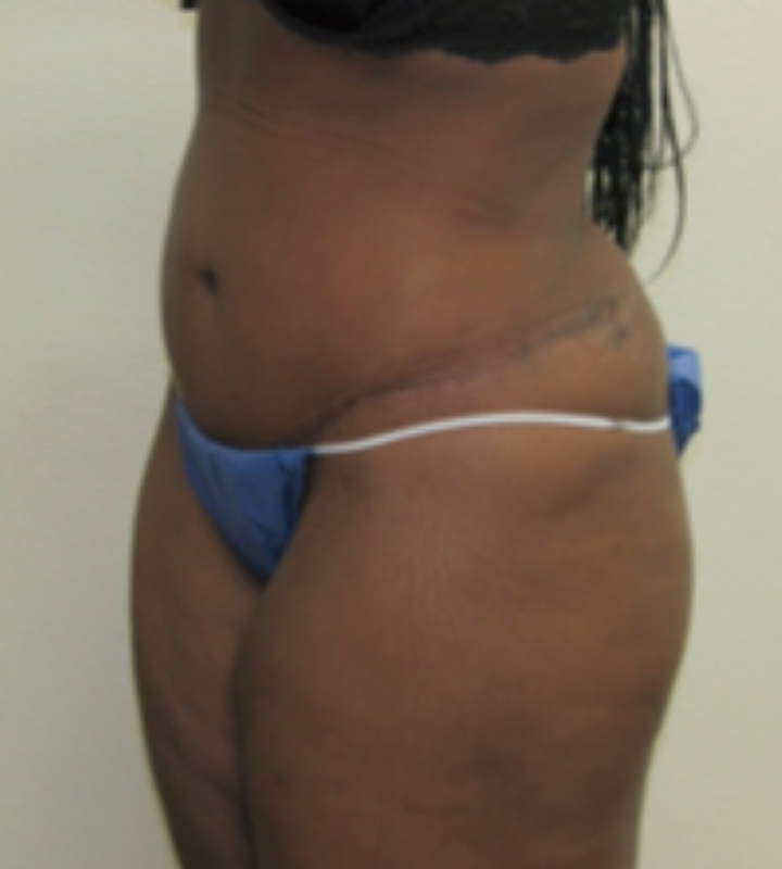 Tummy tuck before & after photo
