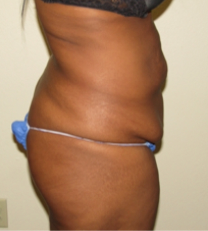 Tummy tuck before & after photo