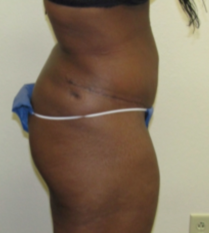 Tummy tuck before & after photo
