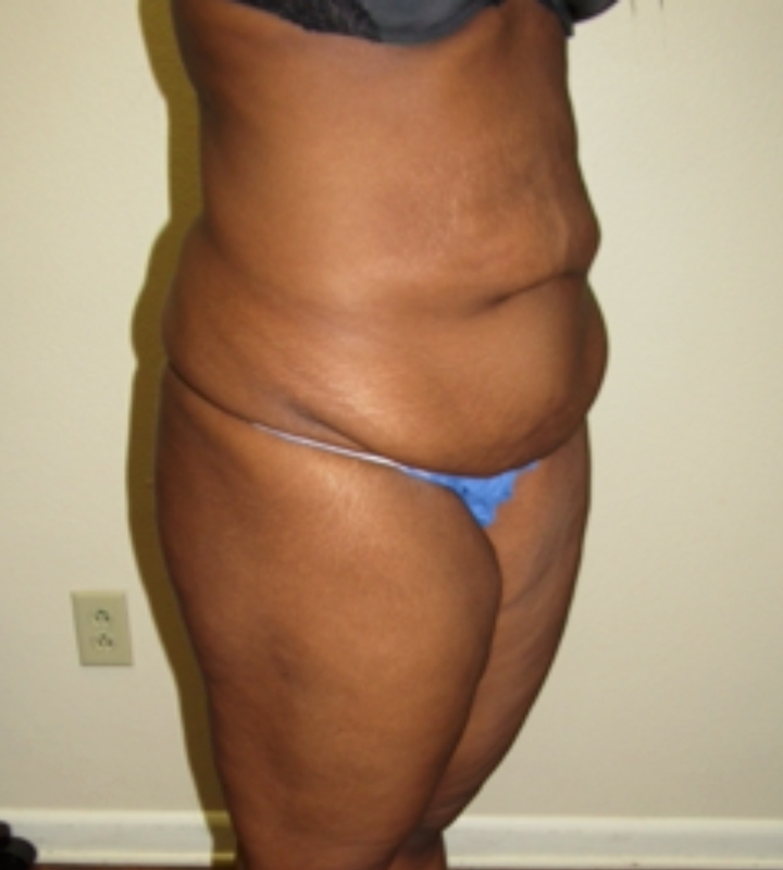 Tummy tuck before & after photo