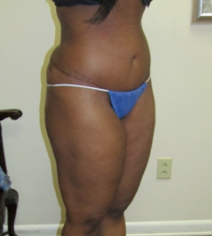 Tummy tuck before & after photo