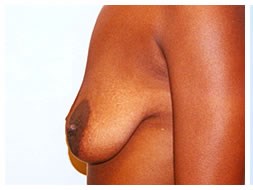 Breast augmentation lift before & after photo