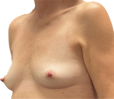 Breast augmentation before & after photo