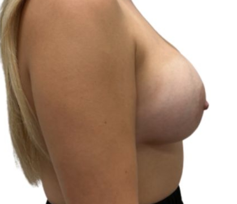 Breast augmentation before & after photo