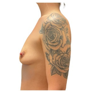 Breast augmentation before & after photo