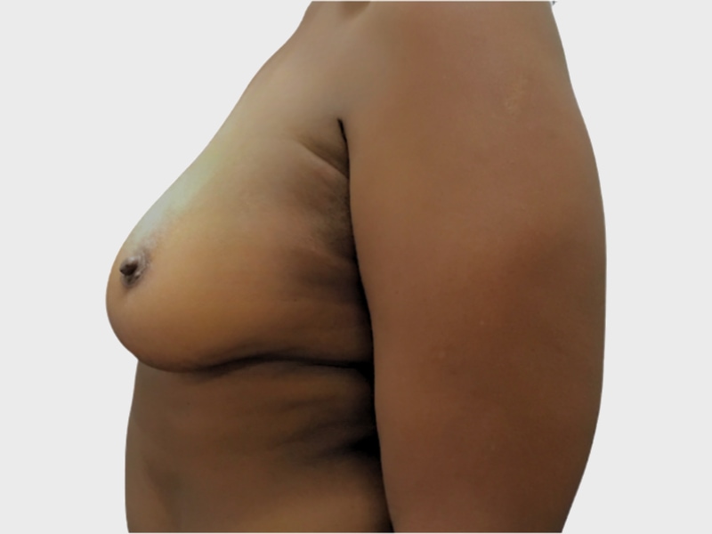 Breast augmentation before & after photo