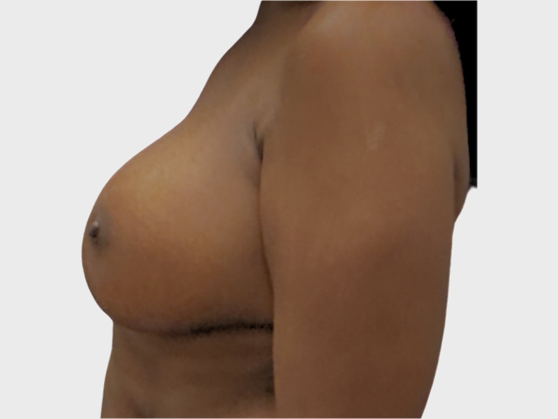 Breast augmentation before & after photo