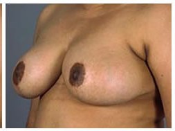 Breast reduction before & after photo