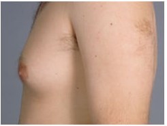 Gynecomastia before & after photo