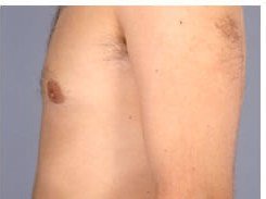 Gynecomastia before & after photo
