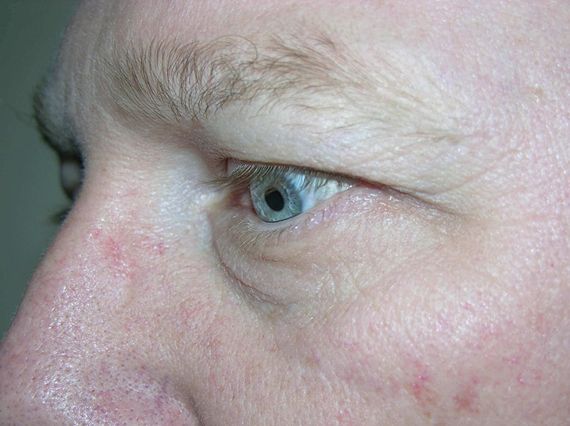 Eyelid lift before & after photo