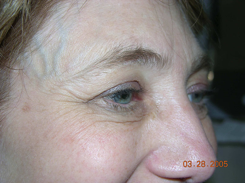 Eyelid lift before & after photo