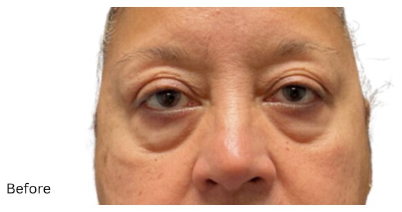 Eyelid lift before & after photo