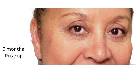Eyelid lift before & after photo