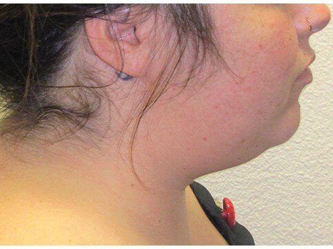 Neck liposuction before & after photo