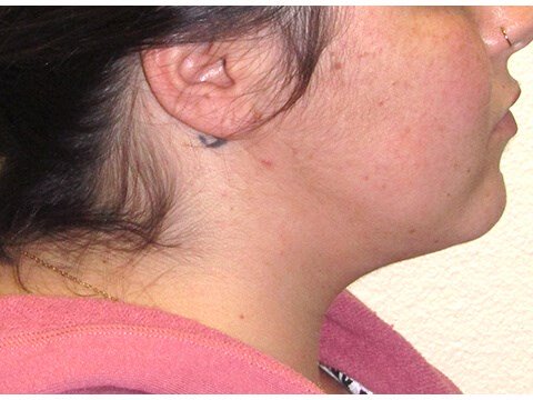 Neck liposuction before & after photo