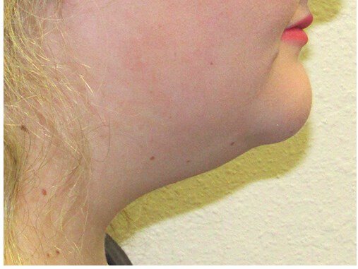 Neck liposuction before & after photo
