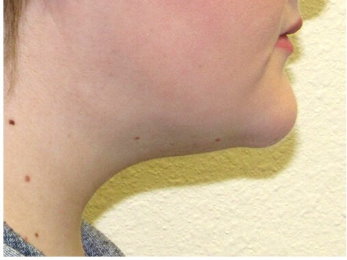 Neck liposuction before & after photo