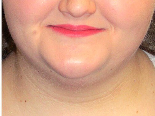 Neck liposuction before & after photo