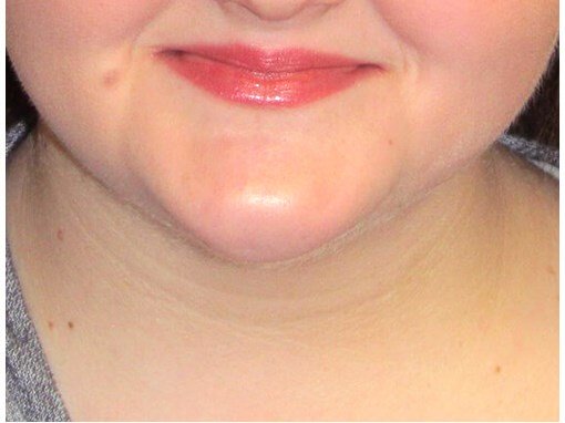Neck liposuction before & after photo