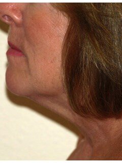 Neck liposuction before & after photo