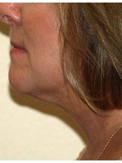 Neck liposuction before & after photo