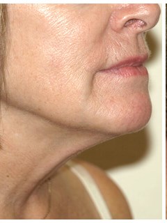 Neck liposuction before & after photo