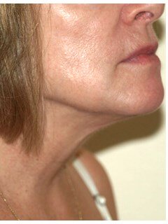 Neck liposuction before & after photo