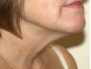 Neck liposuction before & after photo
