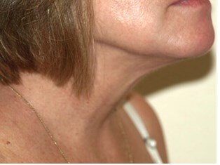 Neck liposuction before & after photo
