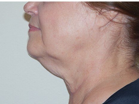 Neck liposuction before & after photo