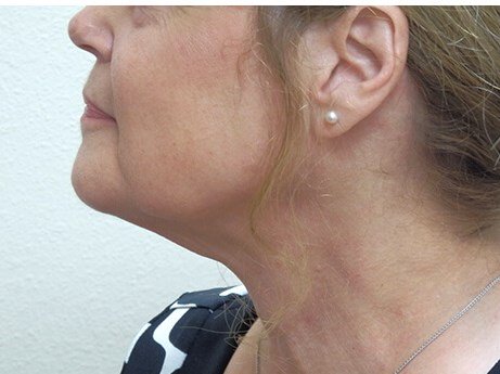 Neck liposuction before & after photo
