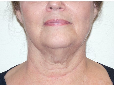 Neck liposuction before & after photo