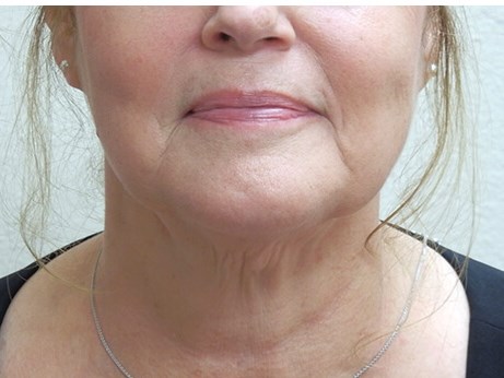 Neck liposuction before & after photo