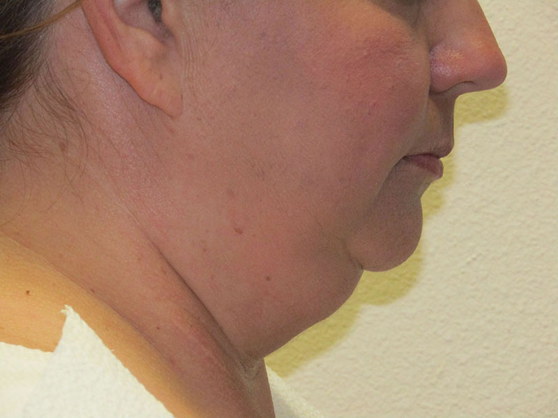 Neck liposuction before & after photo