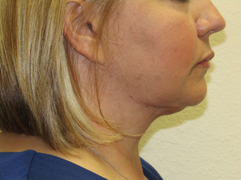 Neck liposuction before & after photo