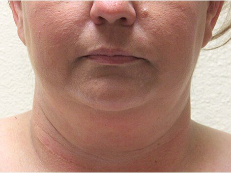 Neck liposuction before & after photo