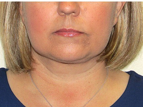 Neck liposuction before & after photo
