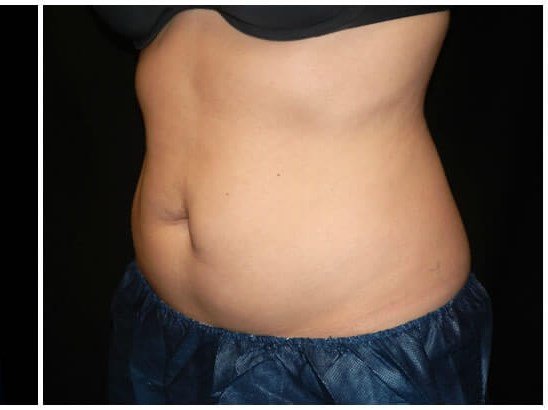 Coolsculpting before & after photo