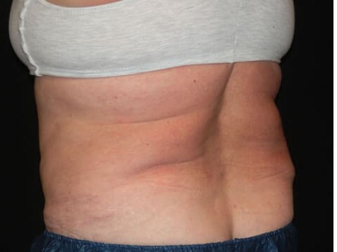Coolsculpting before & after photo
