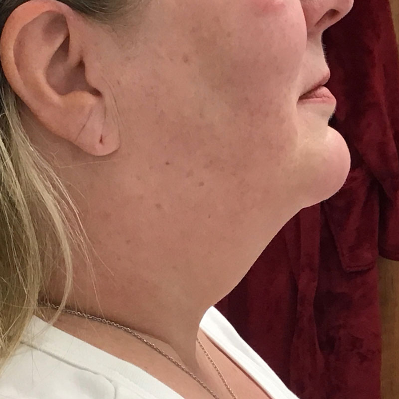 Facetite before & after photo