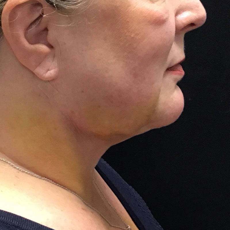 Facetite before & after photo