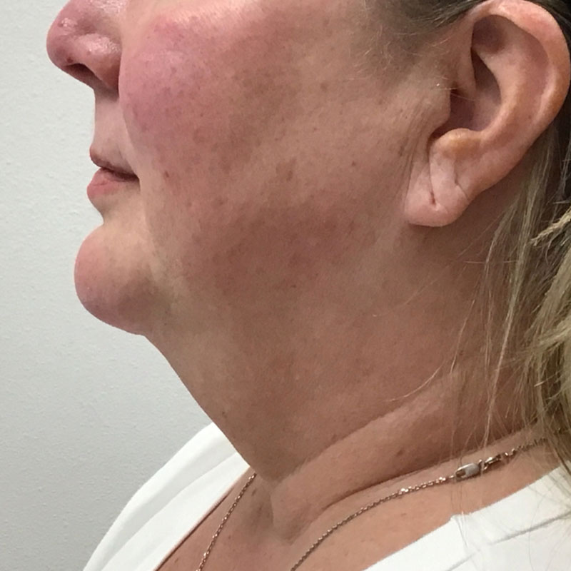 Facetite before & after photo