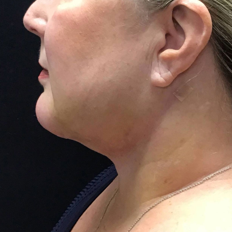 Facetite before & after photo
