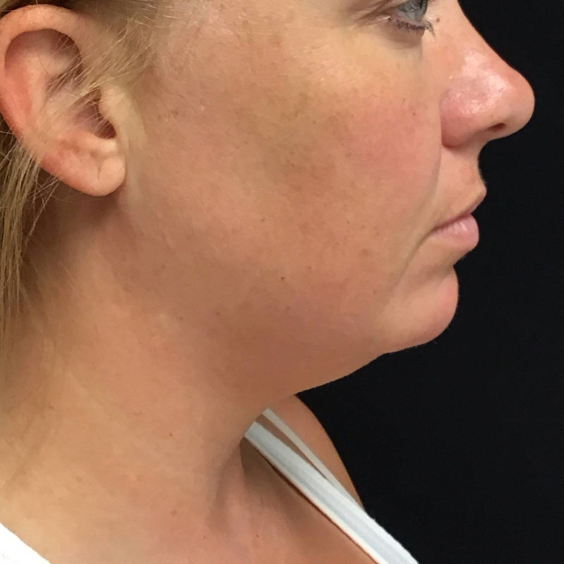 Facetite before & after photo