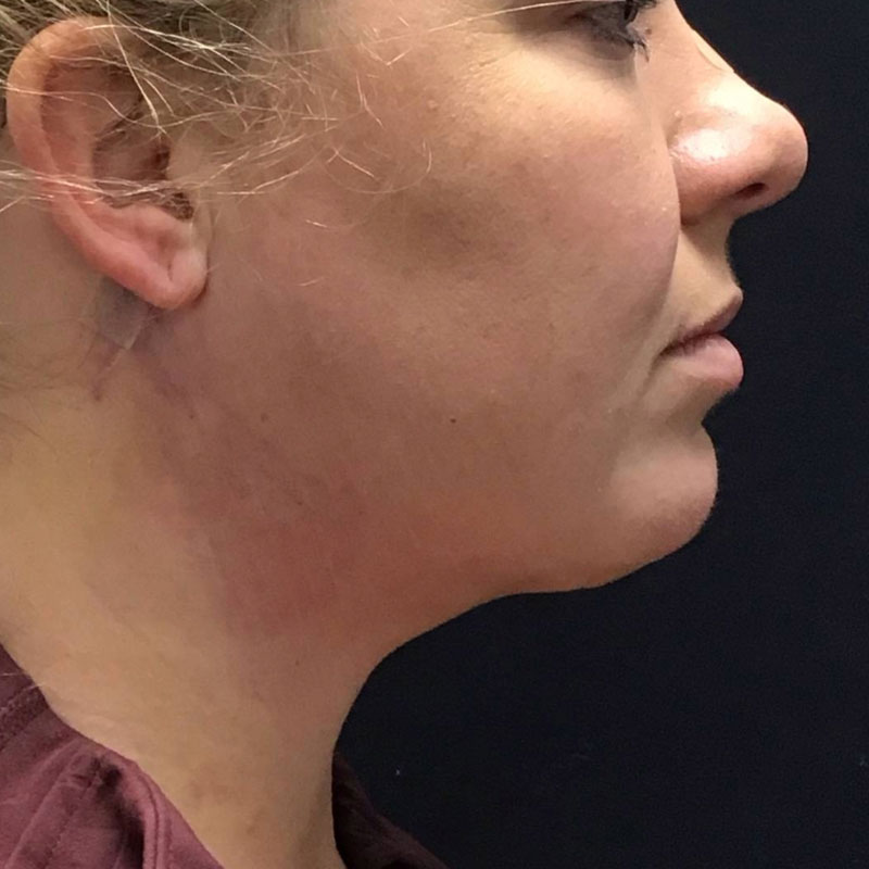Facetite before & after photo