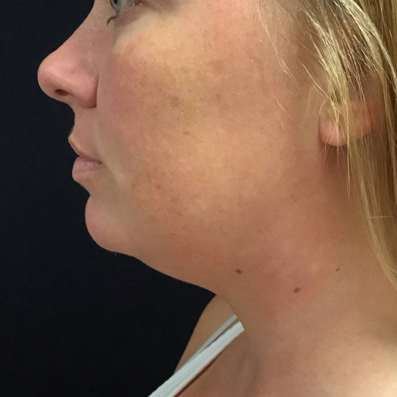 Facetite before & after photo