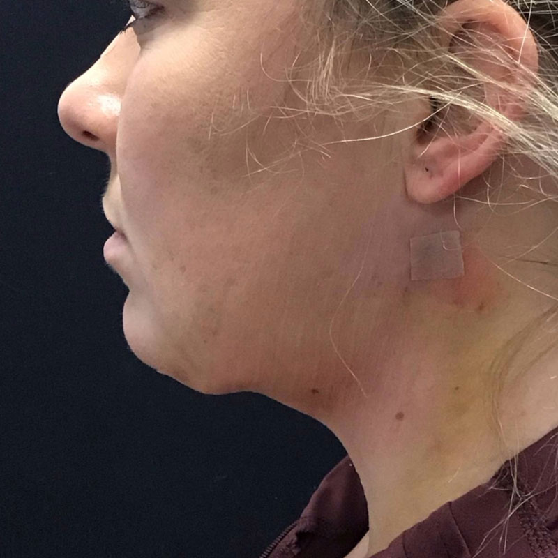 Facetite before & after photo